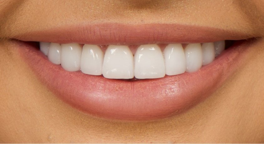 Personalised Smile Makeovers with Porcelain Veneers in London